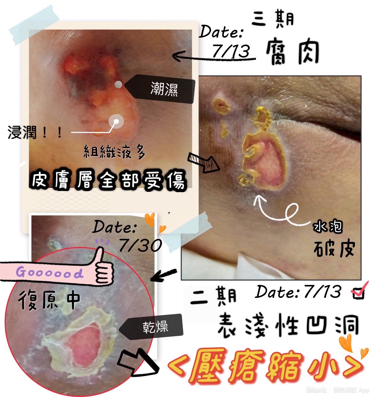 壓傷進程